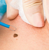 Cirugía Dermatológica